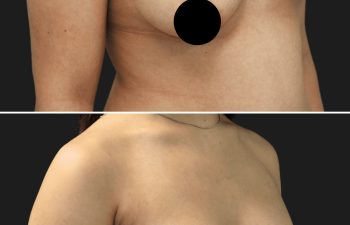 34 year-old before and 7 months and 5 days after right side breast lift, bilateral breast aug, saline sizer