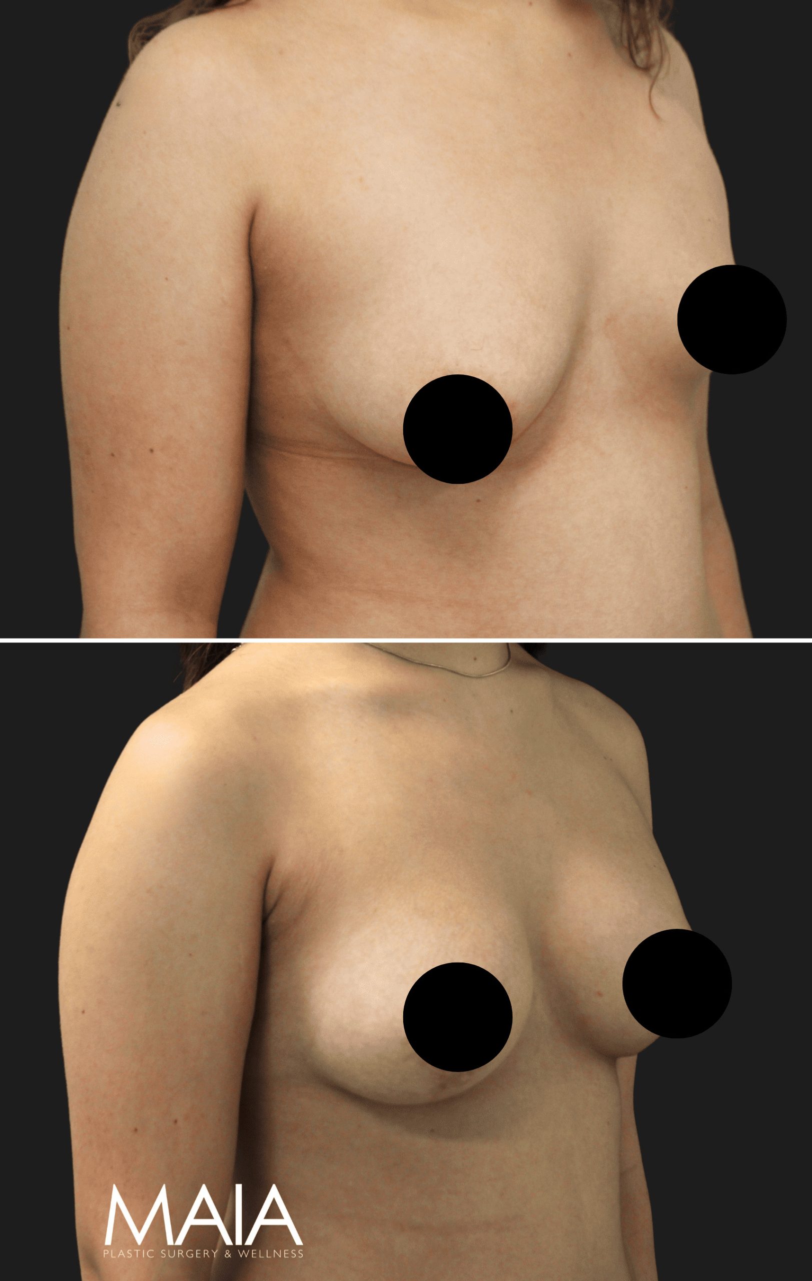 34 year-old before and 7 months and 5 days after right side breast lift, bilateral breast aug, saline sizer