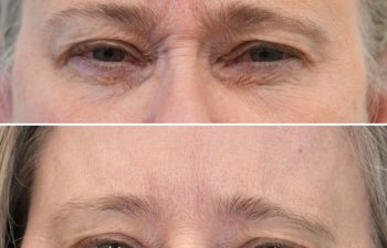 64 year-old patient before and 2 weeks after upper face botox