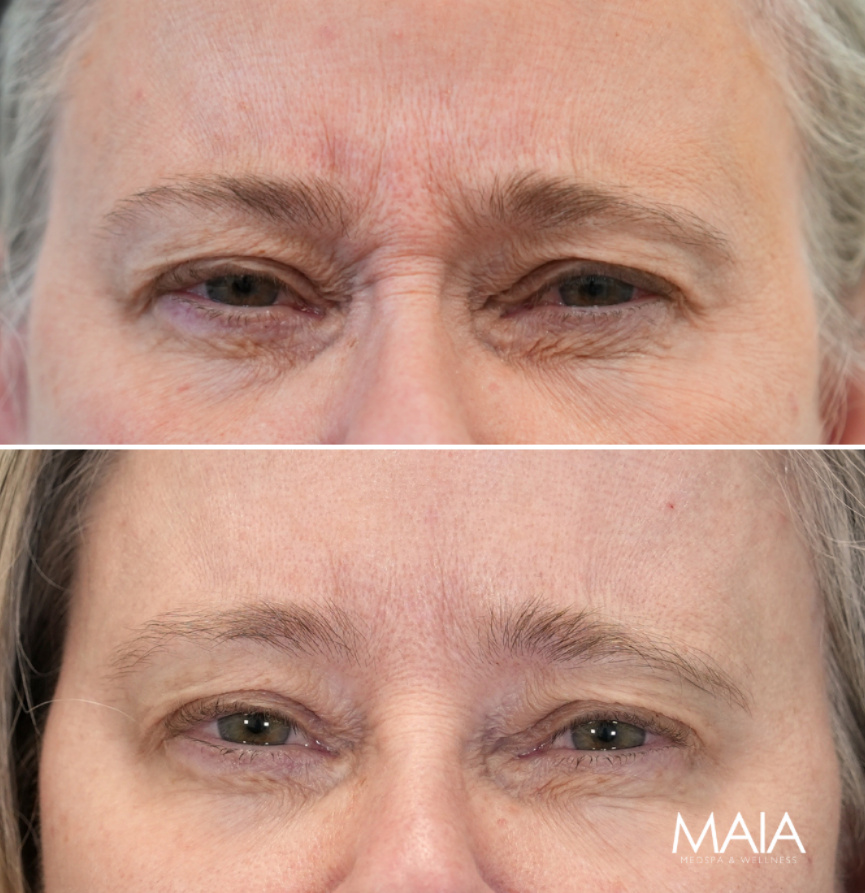 64 year-old patient before and 2 weeks after upper face botox