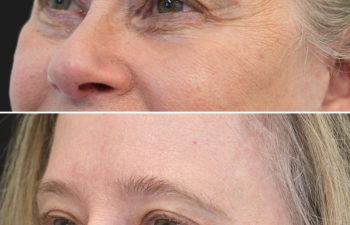 64 year-old patient before and 2 weeks after upper face botox