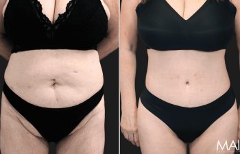 54 year-old before and 4 months & 4 days after extended tt, liposuction of flanks, mid back and lower back