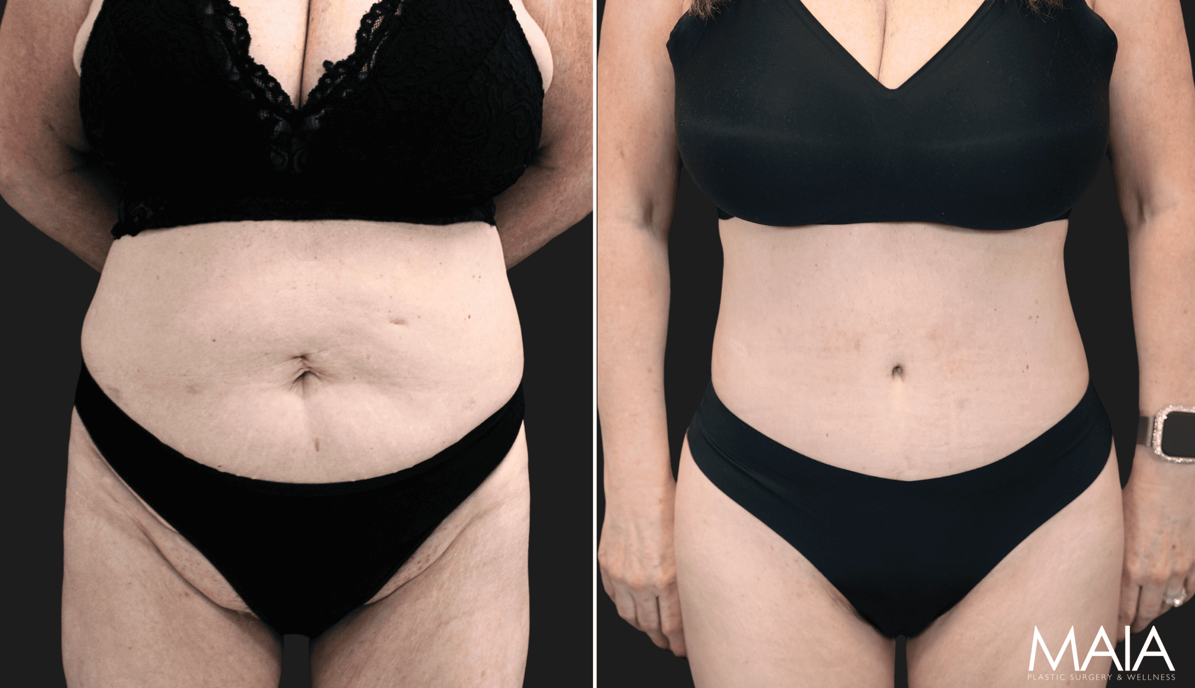 54 year-old before and 4 months & 4 days after extended tt, liposuction of flanks, mid back and lower back