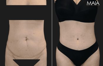 54 year-old before and 4 months & 4 days after extended tt, liposuction of flanks, mid back and lower back