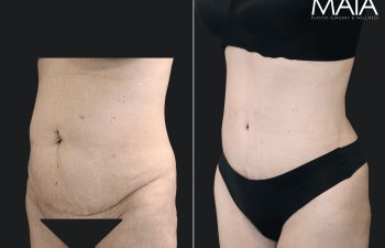 54 year-old before and 4 months & 4 days after extended tt, liposuction of flanks, mid back and lower back