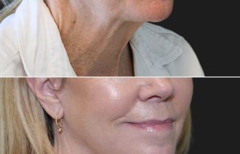 68 year-old patient before and 7 months after The Maia Method by Dr. Munqiue Maia.