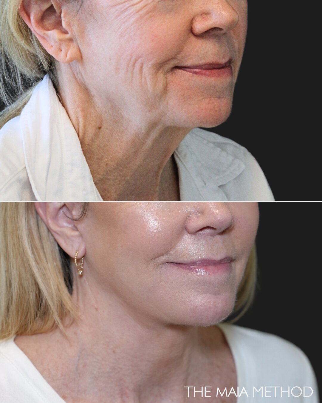 68 year-old patient before and 7 months after The Maia Method by Dr. Munqiue Maia.