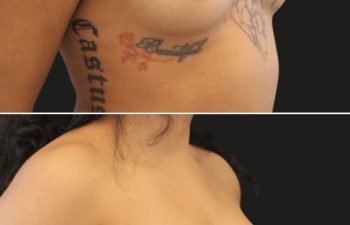 26 year-old before and 7.5 months after breast augmentation | Implant Size: 300cc moderate