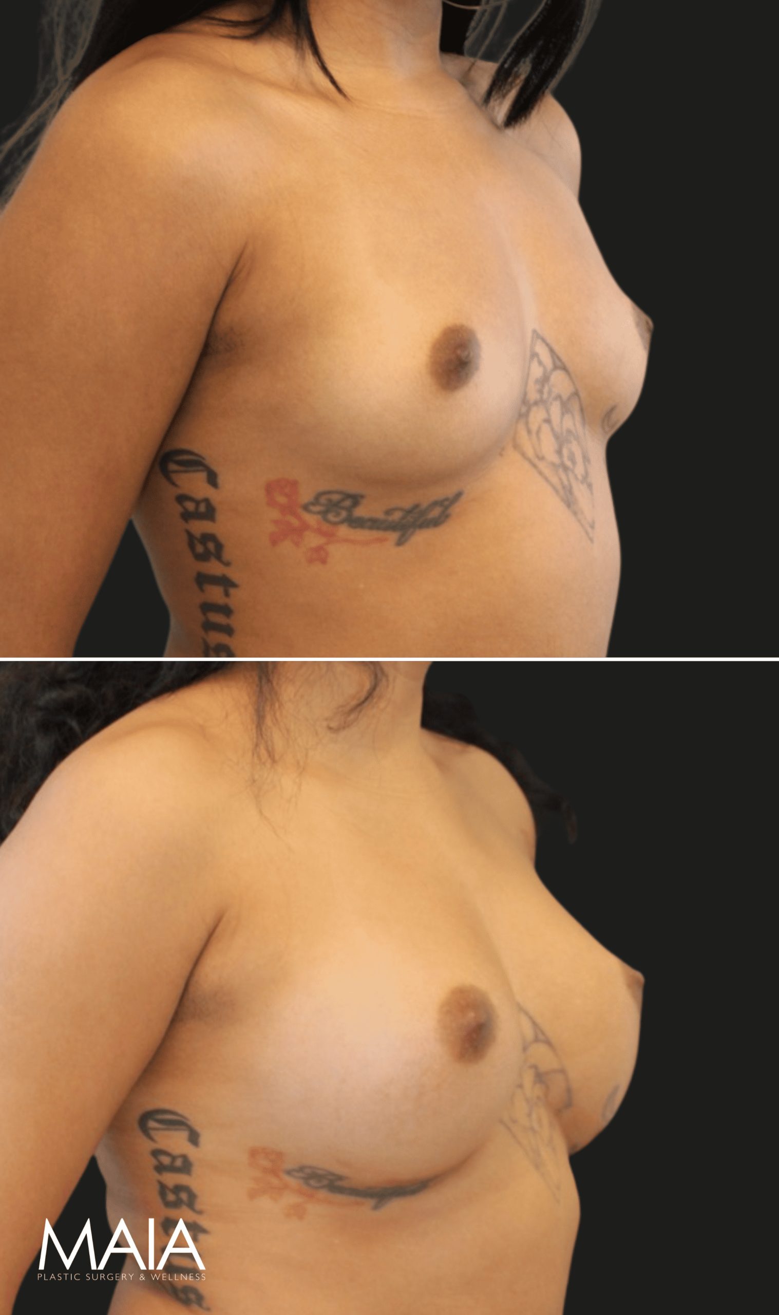 26 year-old before and 7.5 months after breast augmentation | Implant Size: 300cc moderate
