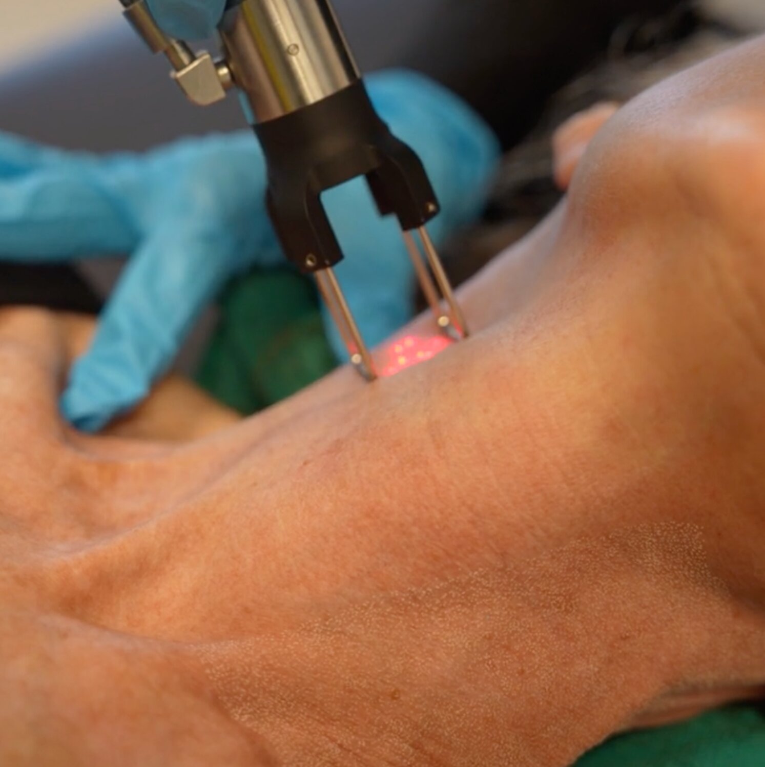 A close-up of a laser skin treatment being performed on a patient's neck and chin area. A gloved practitioner wearing blue nitrile gloves guides a handheld laser device emitting red light dots against the skin. The patient is draped in a green medical cover.
