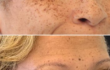 41 year-old patient before and 3 weeks after botox