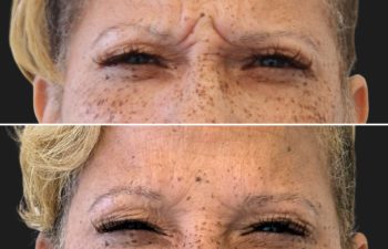 41 year-old patient before and 3 weeks after botox