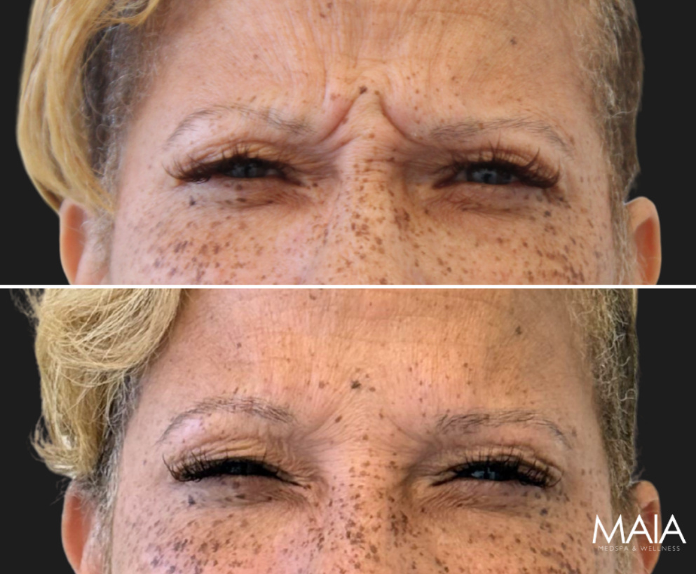 41 year-old patient before and 3 weeks after botox
