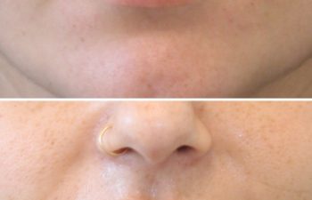 31 year-old patient before and immediately after lip filler
