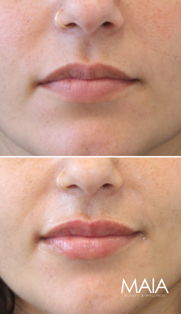 31 year-old patient before and immediately after lip filler