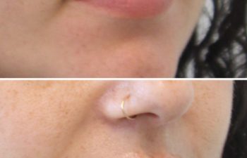 31 year-old patient before and immediately after lip filler