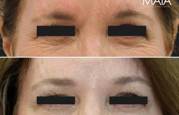 57 year old before and 2 weeks after botox