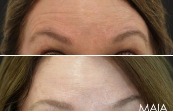 57 year old before and 2 weeks after botox