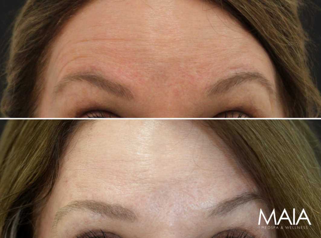 57 year old before and 2 weeks after botox