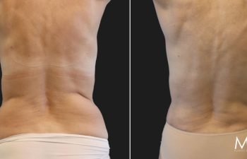69 year-old before and 6 months after liposuction to the back and flanks