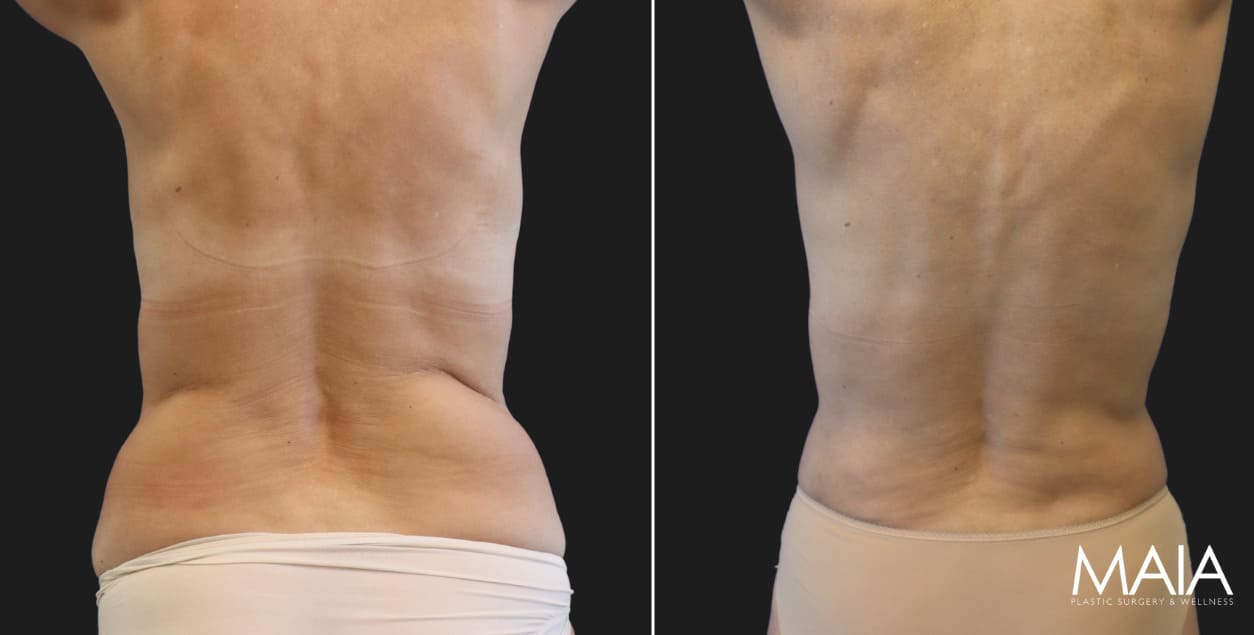 69 year-old before and 6 months after liposuction to the back and flanks