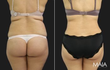 38 year-old mother before and 4 months after tummy tuck and flanks liposuction