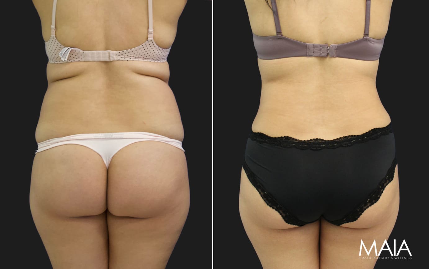 38 year-old mother before and 4 months after tummy tuck and flanks liposuction