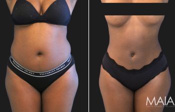 29 year old before and 2 weeks after liposuction of the flanks and abdomen, front view