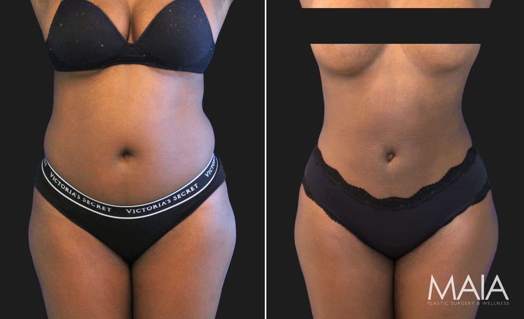 29 year old before and 2 weeks after liposuction of the flanks and abdomen, front view