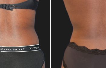 29 year old before and 2 weeks after liposuction of the flanks and abdomen, back view