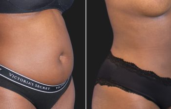 29 year old before and 2 weeks after liposuction of the flanks and abdomen, right oblique view