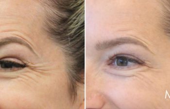 47 year-old patient before and 2 weeks after Botox