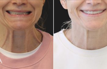 47 year-old patient before and 2 weeks after Botox
