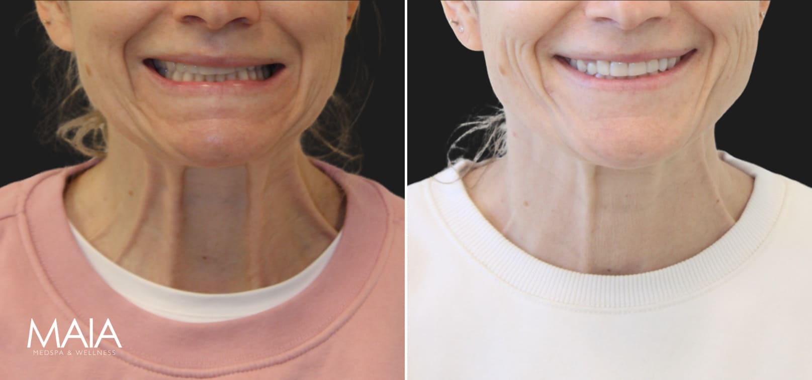 47 year-old patient before and 2 weeks after Botox