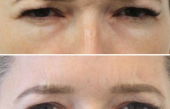 47 year-old patient before and 2 weeks after Botox