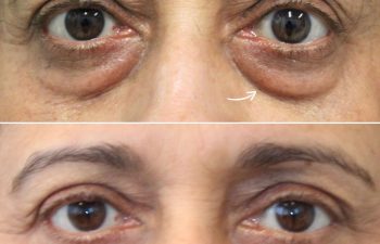 65 year-old before and 7.7 months after lower blepharoplasty and fat grafting