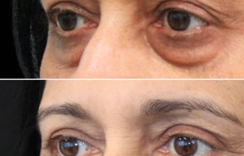 65 year-old before and 7.7 months after lower blepharoplasty and fat grafting