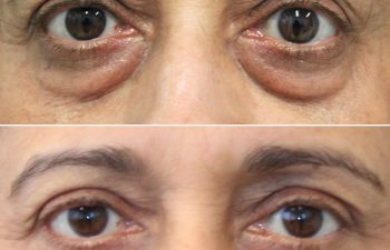 65 year-old before and 7.7 months after lower blepharoplasty and fat grafting