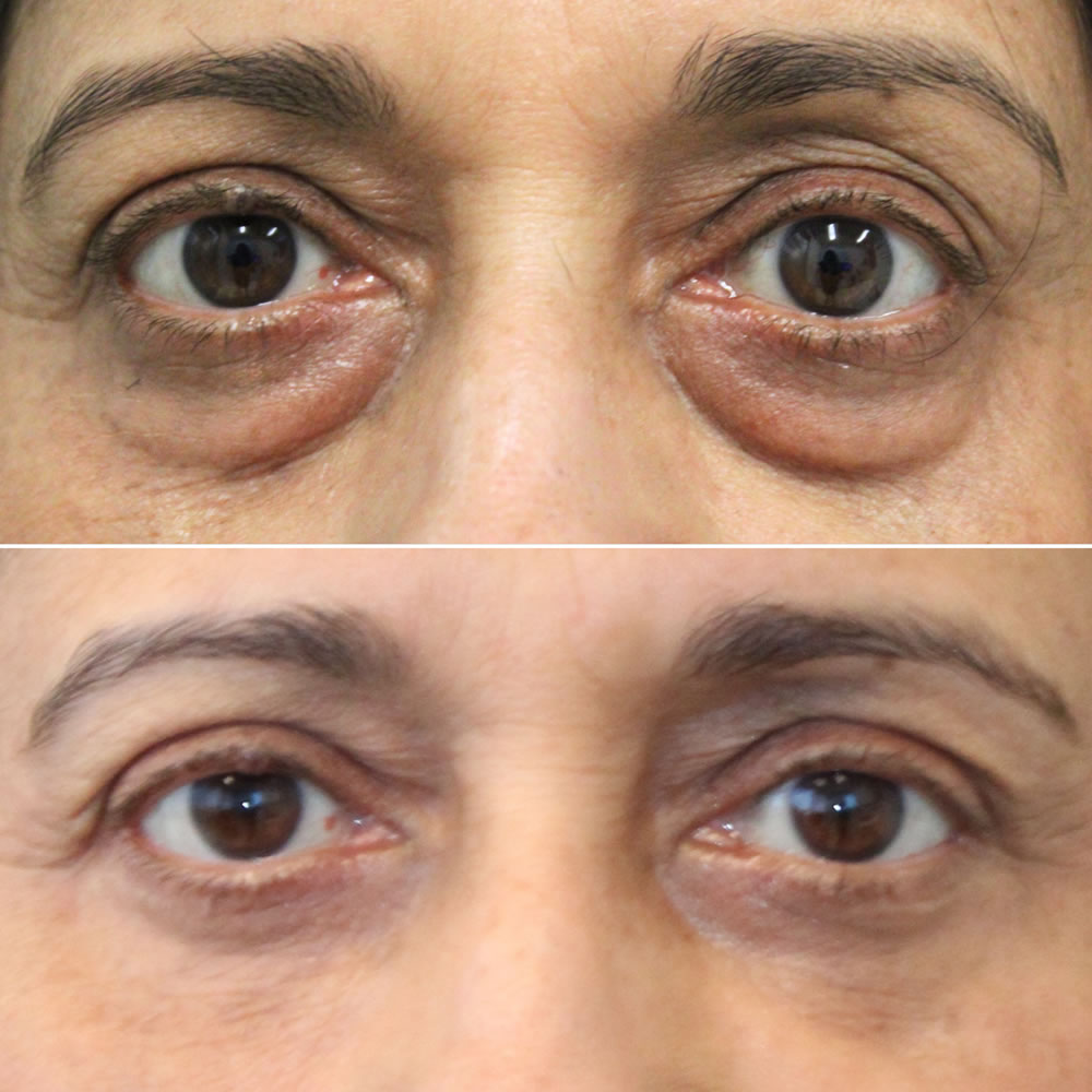 65 year-old before and 7.7 months after lower blepharoplasty and fat grafting