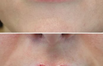 40 year-old before and immediately after lip filler