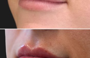 40 year-old before and immediately after lip filler