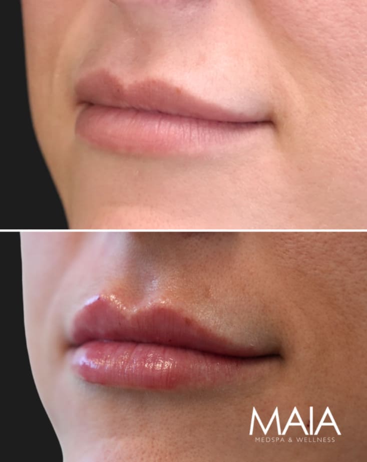 40 year-old before and immediately after lip filler