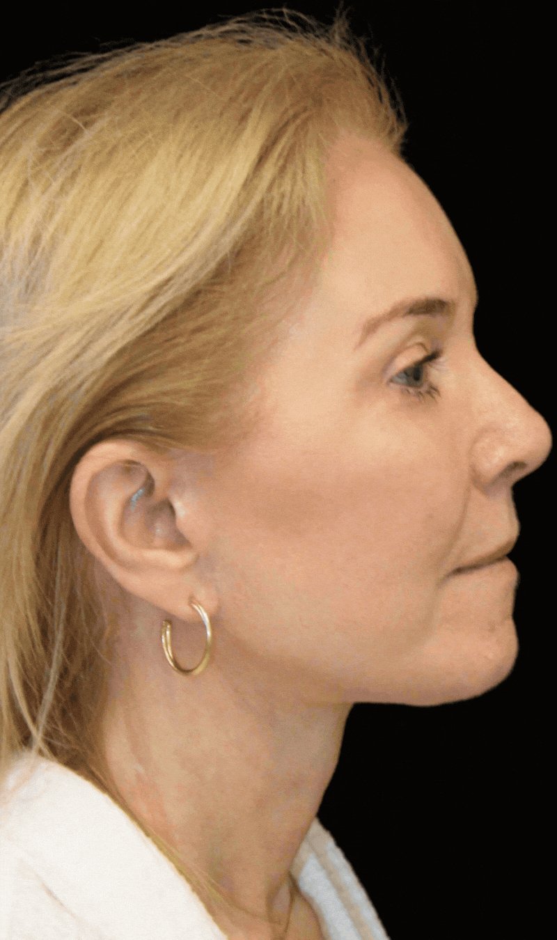 4 year-old patient, 9 Months after The Maia Method: Comprehensive Facial Rejuvenation: Deep Plane Facelift, Neck Lift, Mini Temple Lift, Upper Blepharoplasty, Nanofat & Fat Grafting. Makeup-free skin.
