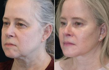 4 year-old patient, 9 Months after The Maia Method: Comprehensive Facial Rejuvenation: Deep Plane Facelift, Neck Lift, Mini Temple Lift, Upper Blepharoplasty, Nanofat & Fat Grafting. Makeup-free skin.