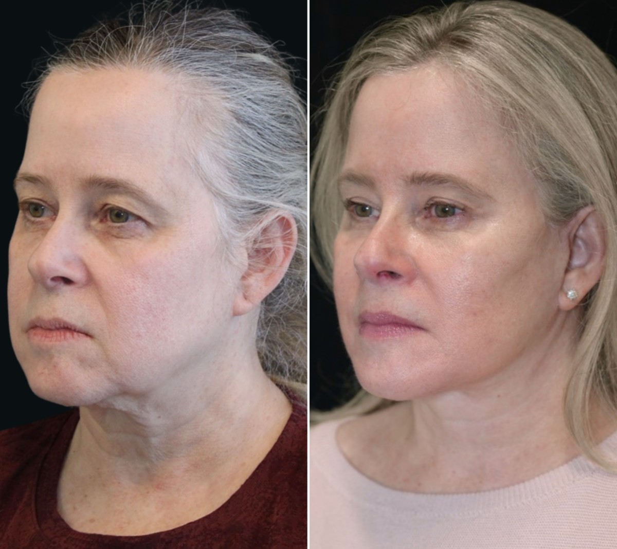 4 year-old patient, 9 Months after The Maia Method: Comprehensive Facial Rejuvenation: Deep Plane Facelift, Neck Lift, Mini Temple Lift, Upper Blepharoplasty, Nanofat & Fat Grafting. Makeup-free skin.