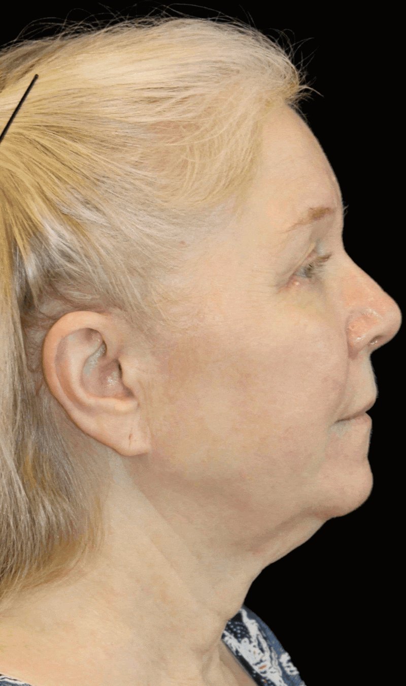 4 year-old patient before The Maia Method: Comprehensive Facial Rejuvenation: Deep Plane Facelift, Neck Lift, Mini Temple Lift, Upper Blepharoplasty, Nanofat & Fat Grafting. Makeup-free skin.