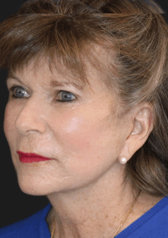 patient after CO2 Laser Resurfacing