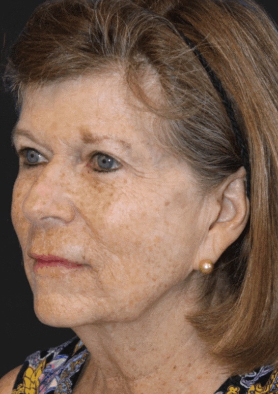 patient before CO2 Laser Resurfacing