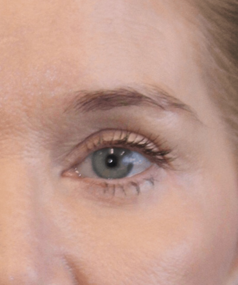 patient after fat grafting treatment