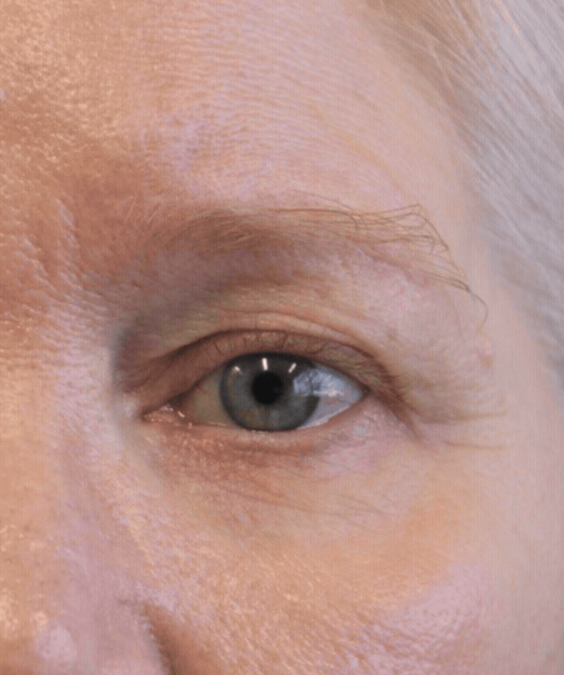 patient before fat grafting treatment